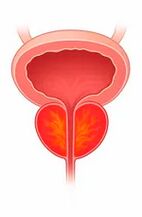Inflamación de la glándula prostática.