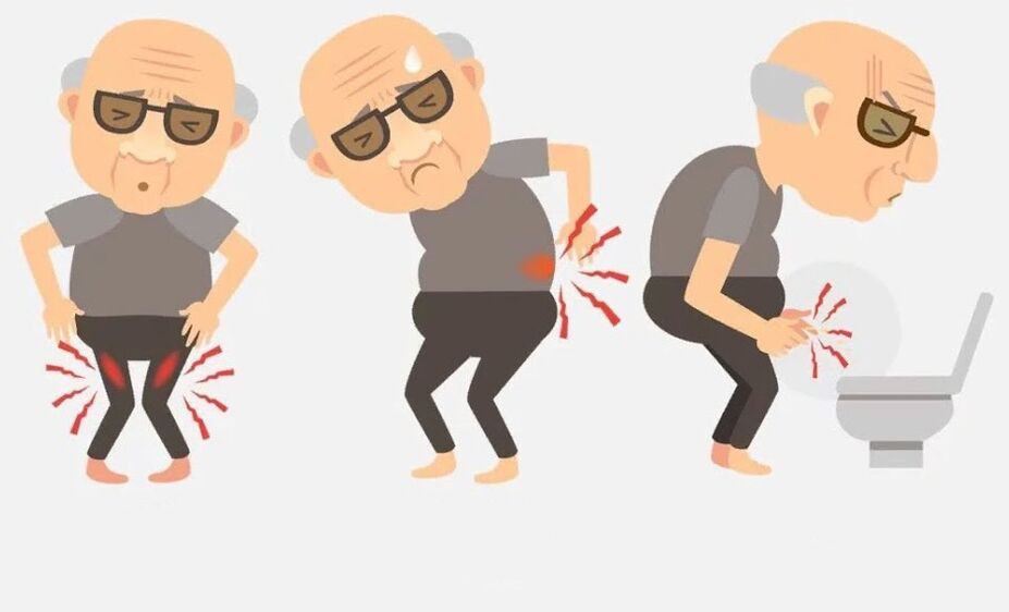 síntomas de prostatitis en hombres