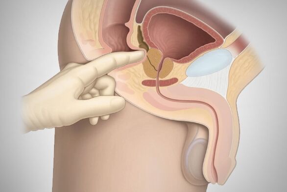Masaje prostático para la prostatitis bacteriana.